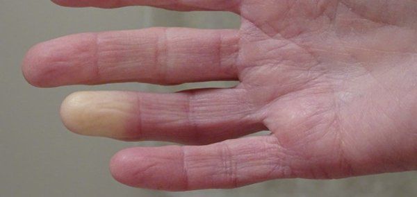 Raynaud-Syndrom
