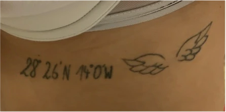 Endovenöse Laserablation