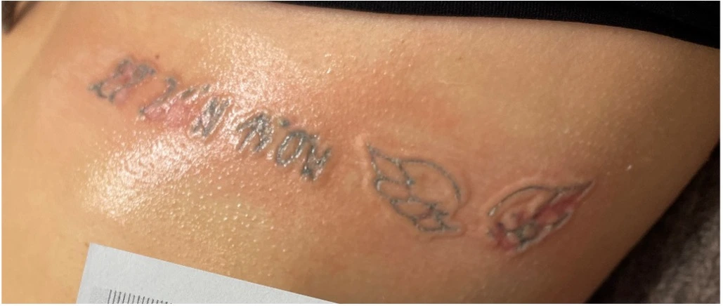 Endovenöse Laserablation