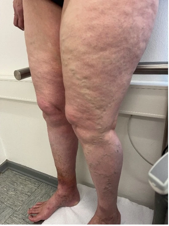 Besenreiser Beispiel