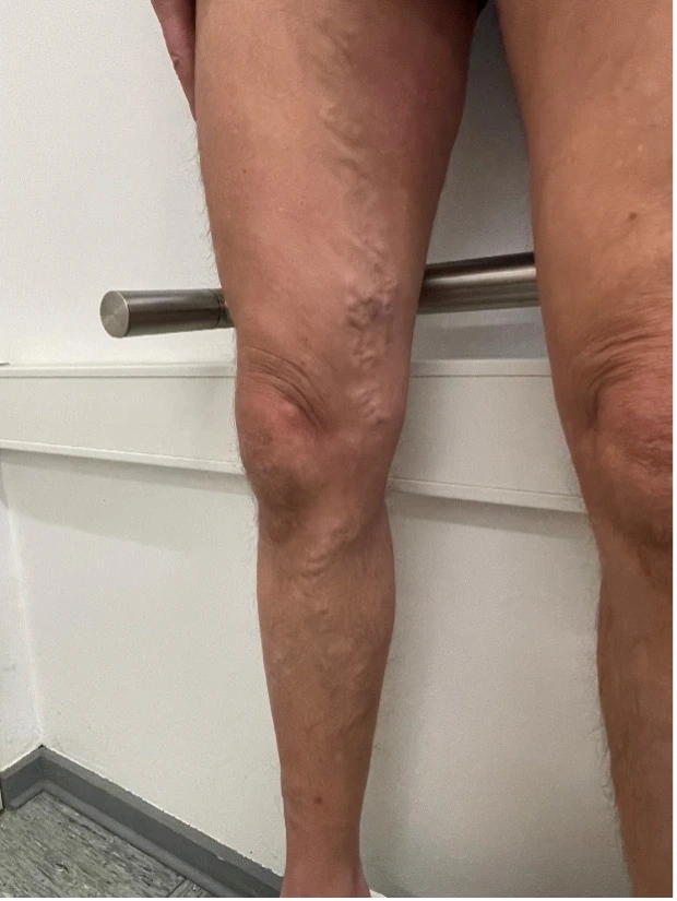 Besenreiser Beispiel